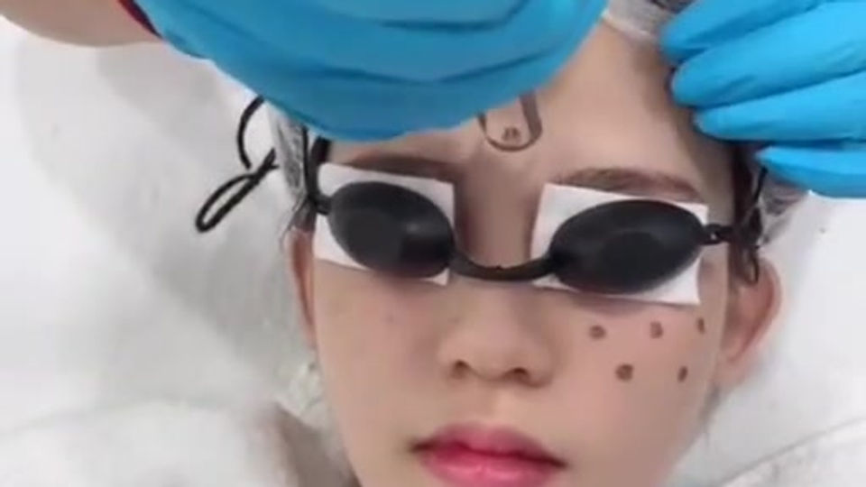 Signature Laser Facial